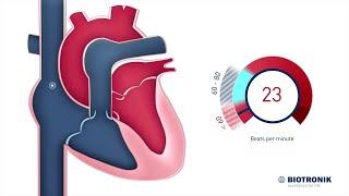 What is a normal vs. a slow heart rate? (Medical Animation)