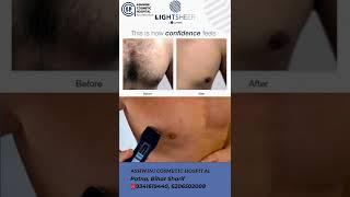 Laser Hair Reduction Men| Chest Hair Removal | Dr Achala Verma| Ashwini CosmeticHospital 9341619440