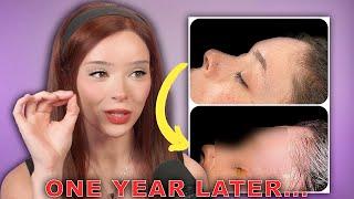 1 Year Facial Feminization Surgery Update! (Sensation, Scarring, Hair Regrowth, +more)