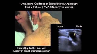 How To: Supraclavicular Approach to Subclavian Vein Cannulation - Sonosite Ultrasound