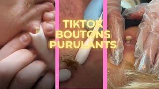 TIKTOK BOUTON PIMPLE POPPING 1