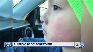 Doctor explains allergy to cold weather