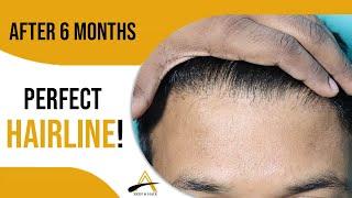 Hairline Restoration with complete natural look (2300 grafts, NW II A), by Dr. Alok Sahoo