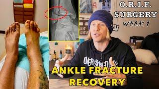 Fractured Ankle Recovery Week 1 | What To Expect After Surgery