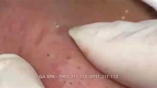 Highlight Professional blackhead popping at its best - GÀ SPA