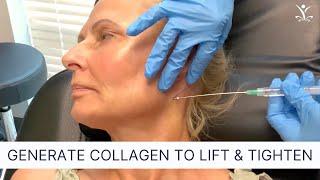 PDO Threads for a Non-Surgical Neck Lift