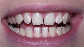 How to fix the gaps in your teeth/smile? - Dentist in Skelmersdale