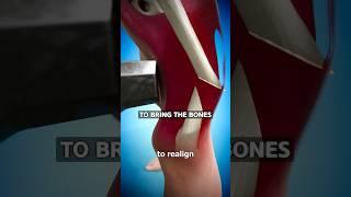 How Broken Bones Are Fixed  Surgeon Reacts