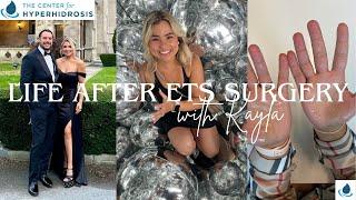 Life after ETS Surgery with Kayla | Palmar Hyperhidrosis