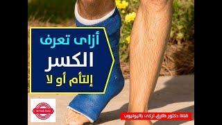 ازاى تعرف الكسر التأم او لا | علامات يعتمد عليها الطبيب فى تشخيص التئام الكسور