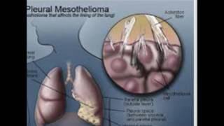 malignant pleural mesothelioma survival rate