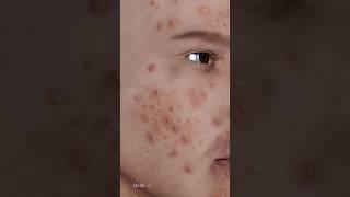 What Exactly Is Acne, Causes of Acne: 3D Animation