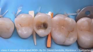 Class II Mesial, Distal and MOD using myClip 2.0 - Dr. Gerdolle