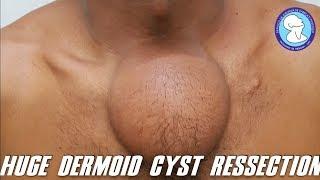 HUGE DERMOID CYST RESSECTION