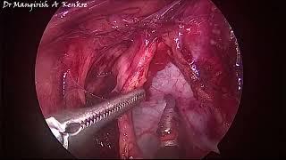 Difficult Laparoscopic Hysterectomy (I) - Goa