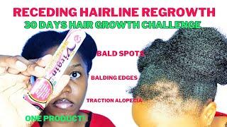 Receding Hairline Regrowth Challenge 30 Days | Balding Edges | Bald Spots #hairgrowthchallenge