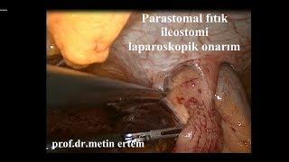 Parastomal Fıtık ( ileostomi). Laparoskopik onarım. Prof Dr Metin Ertem