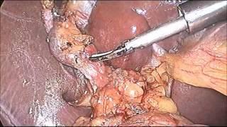 Laparoscopic Cholecystectomy with ligation of cystic duct by Dr R K Mishra