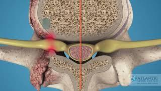 What is Cervical Lateral Stenosis? @AtlanticSpineCenter