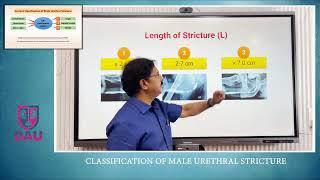 How to classify male urethral stricture ?