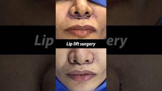 Lip Lift Surgery - Before and After #shorts