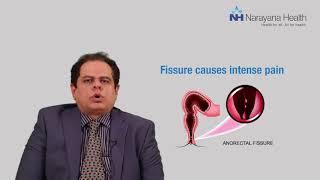 Difference between Piles, Fissures and Fistula | Dr. Vikas Kapur