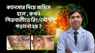 "ক্যানসারের কারণে জন্ডিস হলে কবে পিত্তনালীতে স্টেন্ট বসানো হয়?"