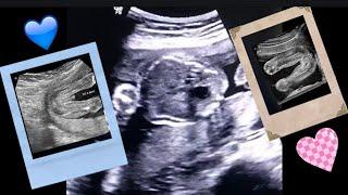 When can you see gender on ultrasound | How to tell gender on ultrasound | Pregnancy Ultrasound