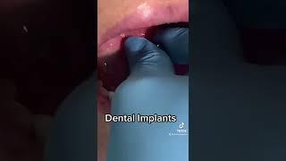 Dental Implants #implant #video #tiktok #video #trending #fyp #love #dentist #shorts #short #smile