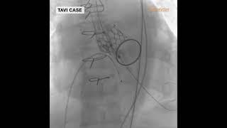 TAVI (Transcatheter Aortic Valve Implantation) Procedure