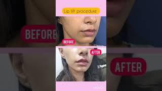 Lip Lift - Amazing Results #shorts #liplift #lips