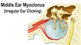 Middle Ear Myoclonus - Irregular Clicking Sound in the Ear