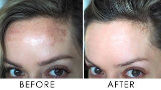 How I Got Rid Of Pigmentation / Melasma | Shonagh Scott