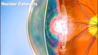 Do you know there are different types of cataracts? Dandelion Medical Animation
