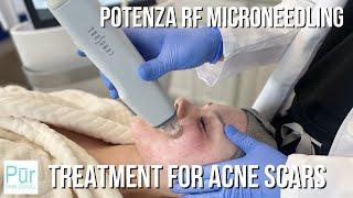 TREATMENT FOR ACNE SCARS | Potenza RF Microneedling in Edmonds, WA | PUR Skin Clinic