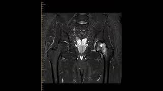 Avascular necrosis (AVN) hip