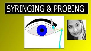 Lacrimal Syringing & Probing | Procedure & Interpretation of Results