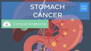 Stomach cancer: Definition, causes, symptoms and treatment | Kenhub