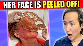 Plastic Surgeon Reacts to Face Peeling Off Videos! #phenol peel