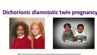 Anatomy of dichorionic and diamniotic twin pregnancy with sonographic feature #twins #twinpregnancy