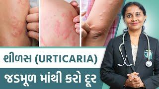 Ayurvedic Treatment Of Urticaria  | Dr. Devangi Jogal | JOGI Ayurved