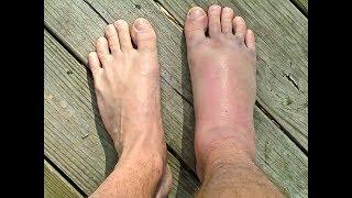 SPRAINED or BROKEN Ankle? : *Doctor Guide!*