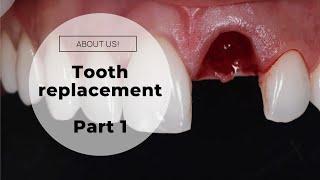 DENTAL IMPLANT (Graphic images - Dentist) - Immediate front tooth replacement Part 1 (Surgery)