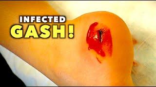 INFECTED GASH ON HER HEEL...(We Had to Deep Clean) | Dr. Paul