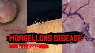 Morgellons: Fibers Coming Out of My Skin? 