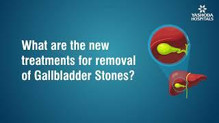 What are the new treatments for removal of Gallbladder Stones?