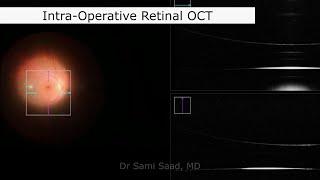 Routine Vitrectomy for Retinal Detachment - with Tips | Dr Sami A. SAAD