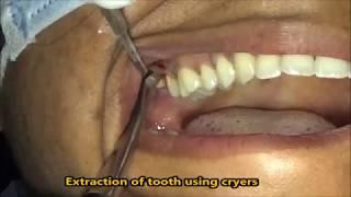 Buccoverted upper 3rd molar extraction