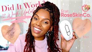 Did IPL work on brown skin? 12 Week Update ft. RoseSkinCo. Lumi Device || IPL Journey