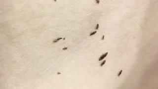 3 Month Lice Infestation